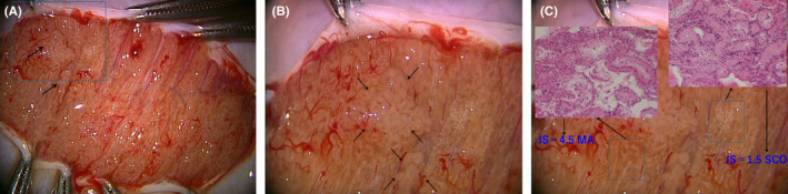 Revisiting non-obstructive azoospermia: Is there a best way to retrieve testicular sperm?