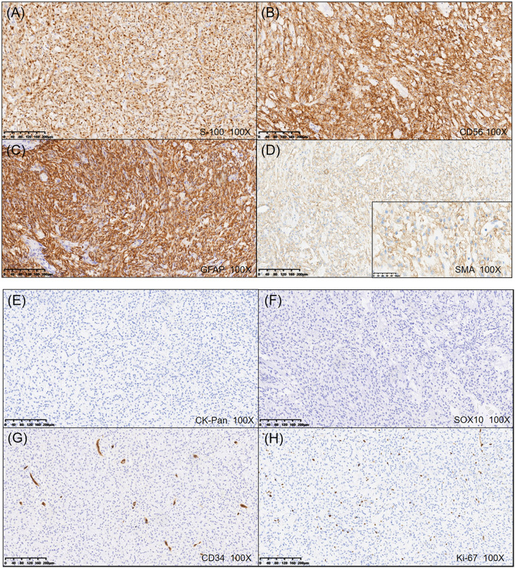 An extralingual Ectomesenchymal chondromyxoid tumor with RREB1::MRTFB fusion: a rare case report of plantar fascia involvement.