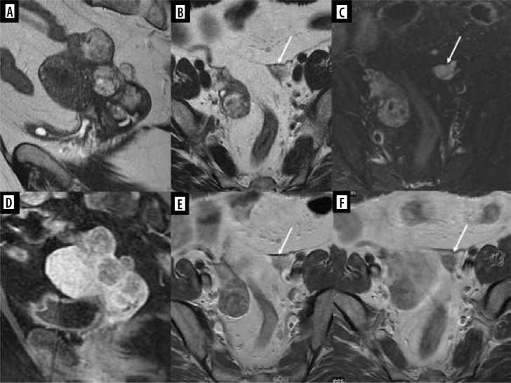 The reproductive system and breast metastases - a narrative review and case series of metastases from soft tissue and bone sarcomas in girls.