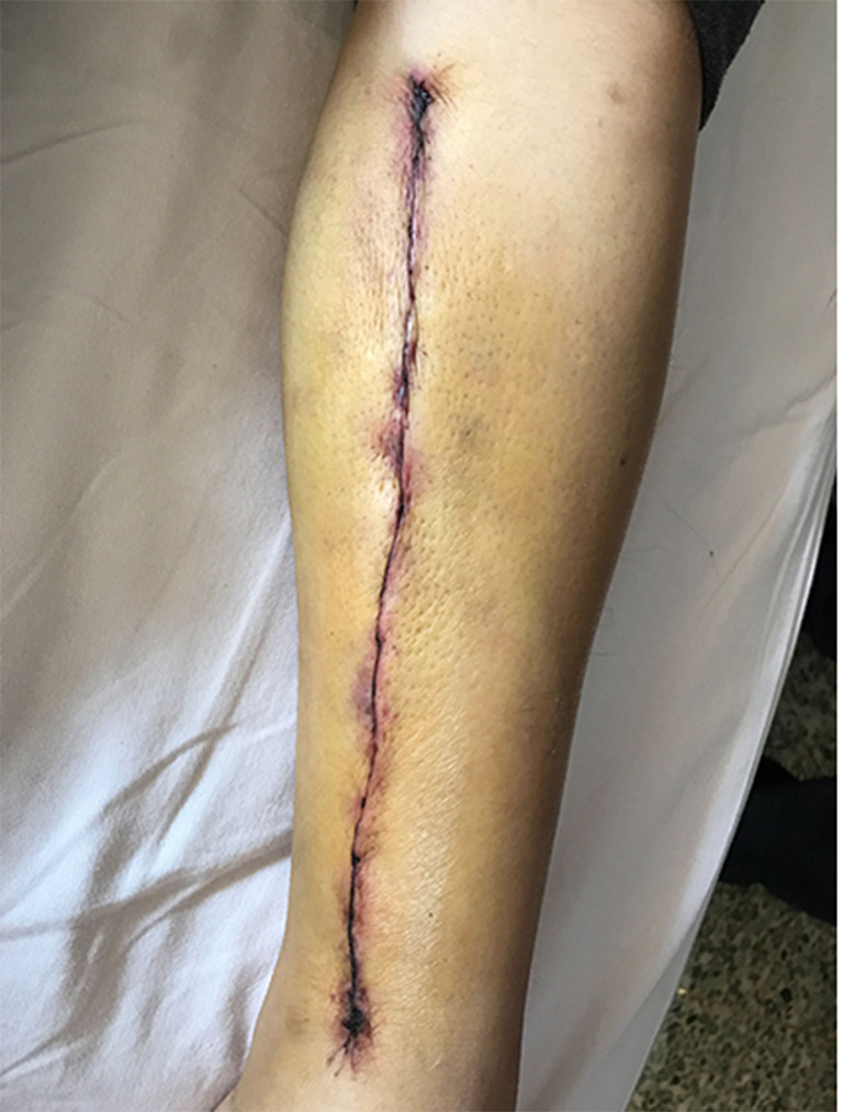 One-year patency rates of saphenous vein grafts harvested using the no-touch technique in off-pump coronary artery bypass grafting.