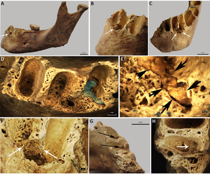 Cemento-Osseous Dysplasia in a Female Bronze Age Skeleton (North Caucasus).