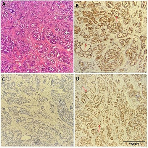 Exploring the efficacy of AMACR, ERG, and AR immunostains in prostatic adenocarcinoma and their association with novel grade groups.