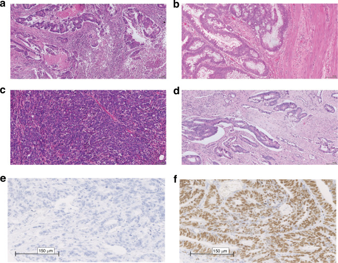 The relationship between tumour necrosis, systemic inflammation, body composition and survival in patients with colon cancer.