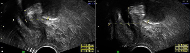 The impact of pelvic floor contraction on urethral mobility and urogenital hiatus size in pelvic floor ultrasound.