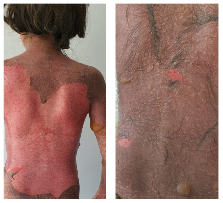 Evaluation of clinical features and treatment modality of pediatric patients with Steven Johnson syndrome/toxic epidermal necrolysis: a single-center experience.
