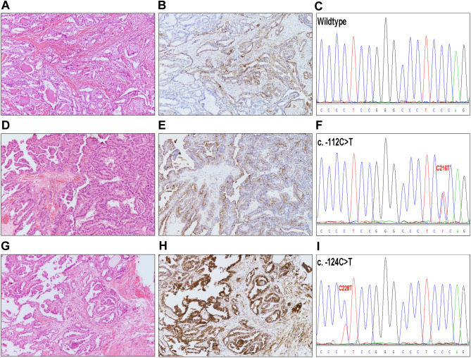 The impact of C216T and hot spot mutations of the TERT promoter on the clinicopathologic characteristics and S100A10 expression in papillary thyroid carcinoma: a comparative study.