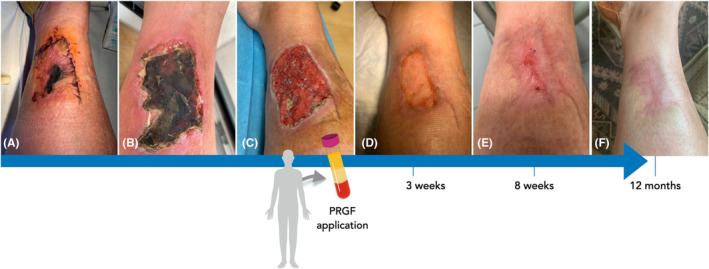 Platelet-rich plasma and plasma rich in growth factors in extra-oral wound care.