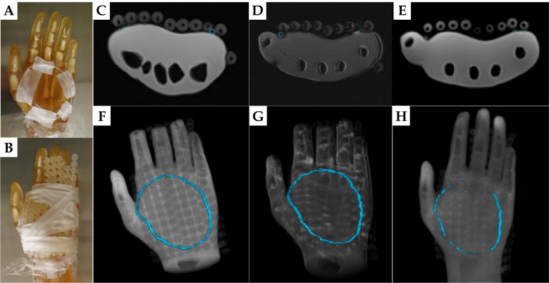 Skin marker for MR-only surface high-dose-rate brachytherapy.