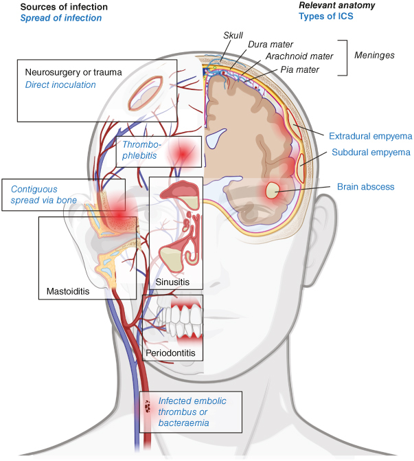 <i>Streptococcus intermedius</i>: an underestimated pathogen in brain infection?