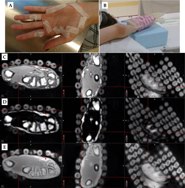 Skin marker for MR-only surface high-dose-rate brachytherapy.