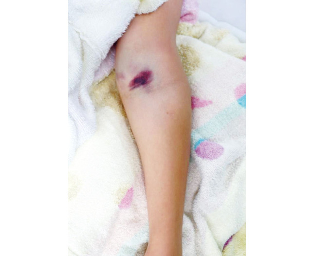 Ulnar nerve snagged on Kirschner wire following surgery for supracondylar fracture of humerus.