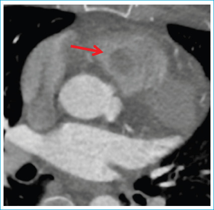 Intracardiac Glomus Tumor Obstructing the Right Ventricular Outflow Tract: A Rare Case Report.