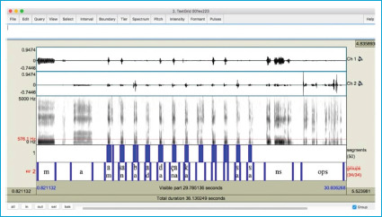 The Effects of Nasal Surgeries on the Acoustics of Nasal Consonants.