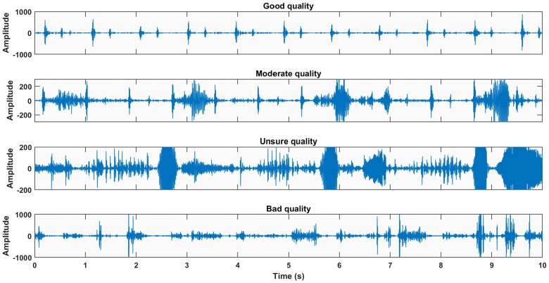 Smartphone for heart sound measurement in hospital: feasibility and influencing factors.