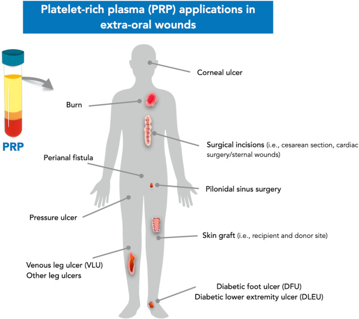 Platelet-rich plasma and plasma rich in growth factors in extra-oral wound care.
