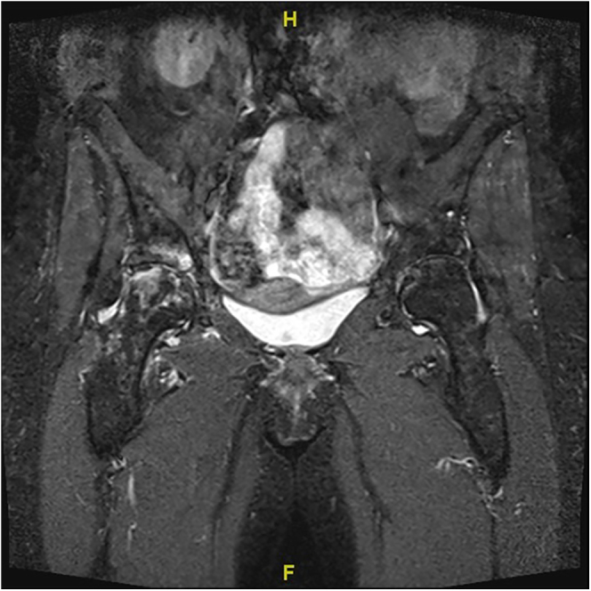 Ochronotic arthropathy: skeletal manifestations and orthopaedic treatment.