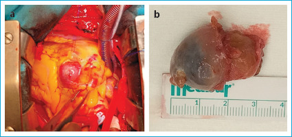Intracardiac Glomus Tumor Obstructing the Right Ventricular Outflow Tract: A Rare Case Report.