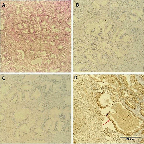 Exploring the efficacy of AMACR, ERG, and AR immunostains in prostatic adenocarcinoma and their association with novel grade groups.