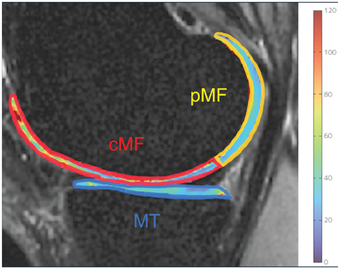 Longitudinal Changes in Medial Meniscal Extrusion After ACL Injury and Reconstruction and Its Relationship With Cartilage Degeneration Assessed Using MRI-Based T1ρ and T2 Analysis.