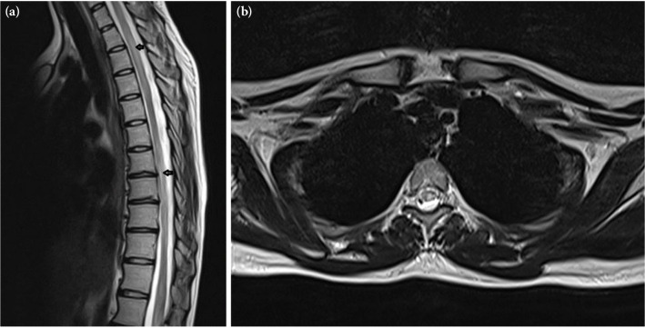 A case report of acute idiopathic longitudinal extensive transverse myelitis.