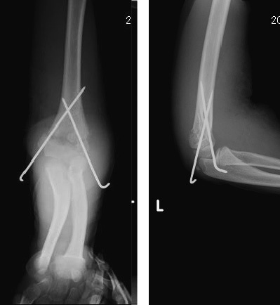 Ulnar nerve snagged on Kirschner wire following surgery for supracondylar fracture of humerus.