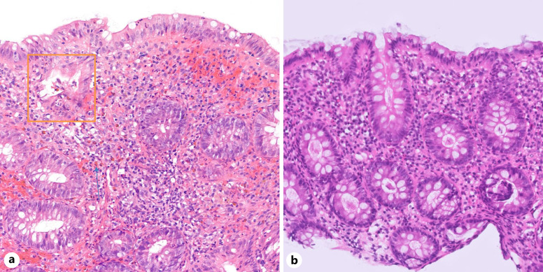 Inflammatory Bowel Disease in a Patient Returning from Colombia: Association with Dipeptidyl Peptidase 4 Inhibitor?