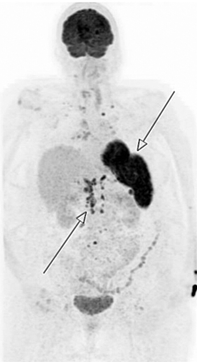 Diagnostic Challenges in a Case of Refractory Severe Hypercalcemia Due to Splenic Sarcoidosis.
