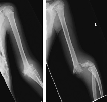 Ulnar nerve snagged on Kirschner wire following surgery for supracondylar fracture of humerus.