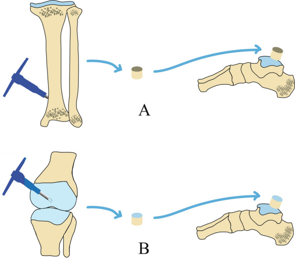 Osteoperiosteal versus osteochondral for autologous transplantation in the treatment of large cystic osteochondral lesions of the talus.
