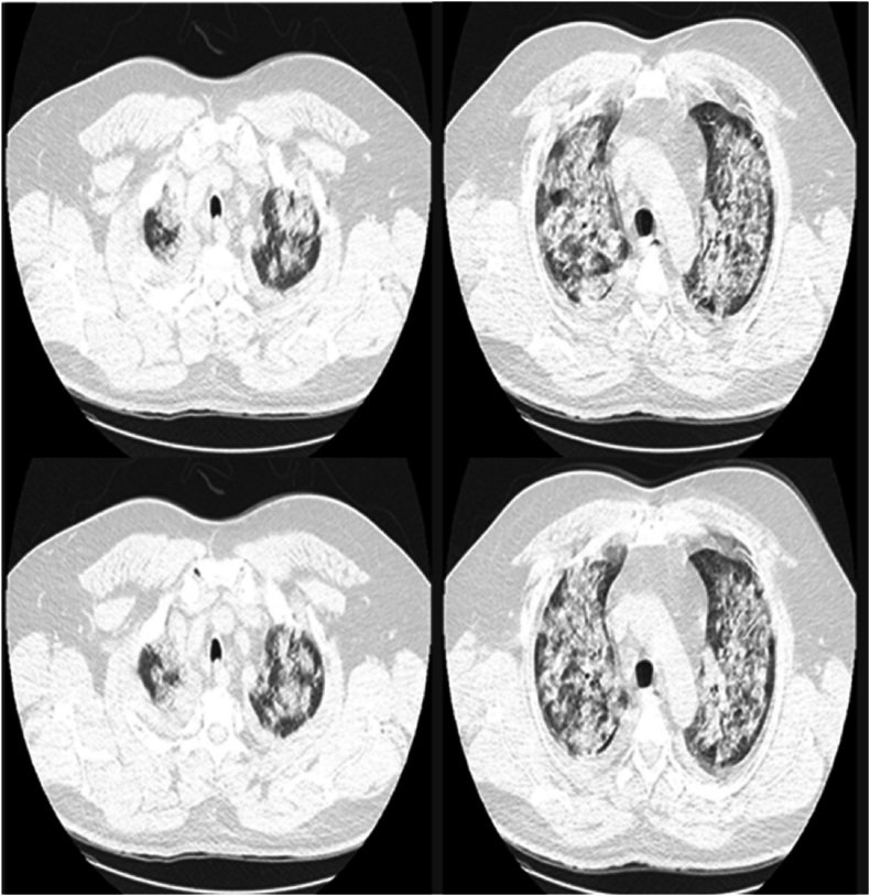 Hantavirus pulmonary syndrome in a COVID-19 patient, Bolivia, 2022