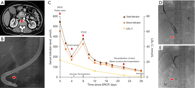 Evolocumab induced short-term biliary stent blockage and acute cholangitis in a jaundice patient with pancreatic carcinoma: a rare complication of PCSK9 inhibitor.