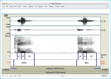 The Effects of Nasal Surgeries on the Acoustics of Nasal Consonants.