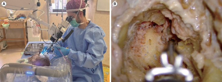 Robotic Versus Manual Electrode Insertion in Cochlear Implant Surgery: An Experimental Study.
