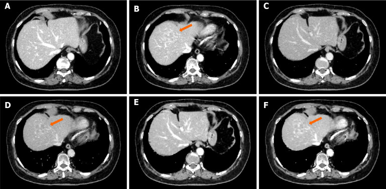 Equilibrium phase images of the liver using a contrast-enhancement boost instead of the portal vein phase.