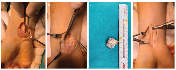 Comparative Outcomes of Open Surgical Excision for Dorsal and Volar Wrist Ganglion Cysts: A Minimum 2-Year Follow-Up Study.