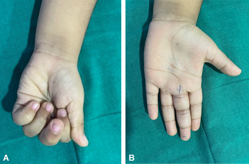 Flexor Tendon Tenosynovitis in a Child Following Missed Thorn Prick Injury: A Case Report.