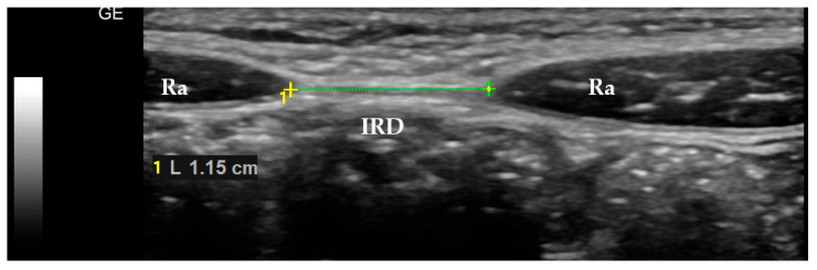 The Linea Alba Width, Children's Physical Activity, and Chosen Anthropometric Measurements: The Results of the Cross-Sectional Study.