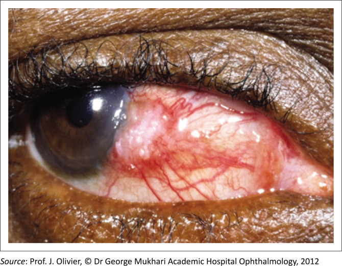 The critical role of primary care clinicians in the early detection of ocular surface squamous neoplasia.
