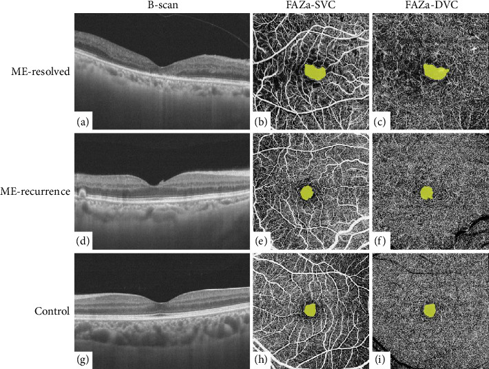 Structural and Vascular Features of Macula Related to the Recurrence of Macular Edema in Central Retinal Vein Occlusion After Anti-VEGF Therapy.