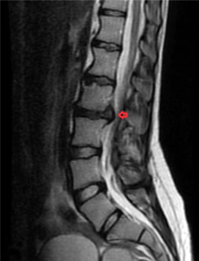 A case report of acute idiopathic longitudinal extensive transverse myelitis.