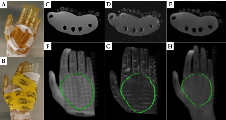 Skin marker for MR-only surface high-dose-rate brachytherapy.