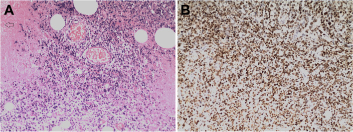 Detection of the 30-bp deletion and protein expression of Epstein-Barr virus latent membrane protein 1 in extranodal NK/T cell lymphoma and its clinicopathological significance.