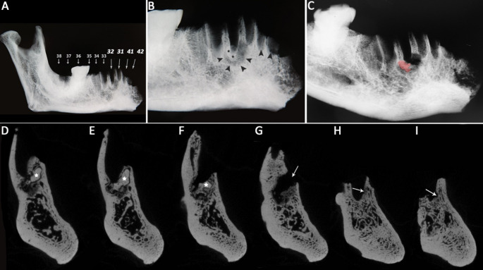 Cemento-Osseous Dysplasia in a Female Bronze Age Skeleton (North Caucasus).