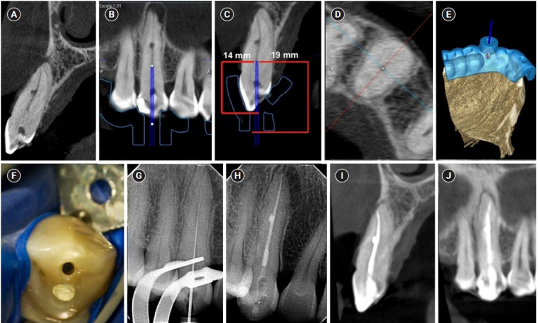 Guided endodontics, precision and predictability: a case series of mineralized anterior teeth with follow-up cone-beam computed tomography.