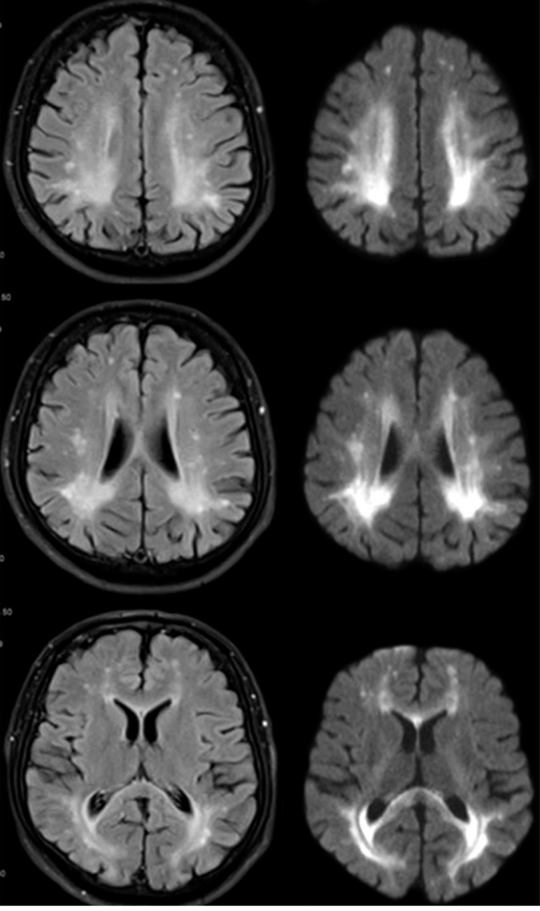 Neurological manifestations in an adult with phenylketonuria.