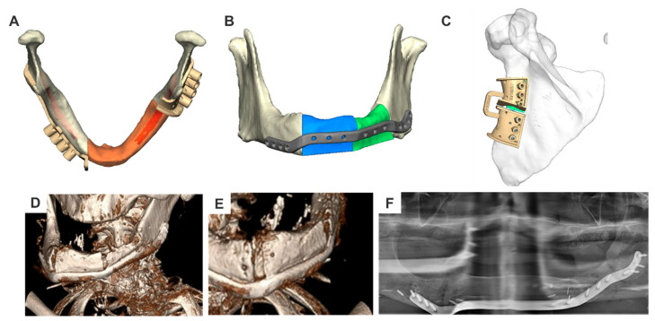 Patient-Specific Solutions for Cranial, Midface, and Mandible Reconstruction Following Ablative Surgery: Expert Opinion and a Consensus on the Guidelines and Workflow.