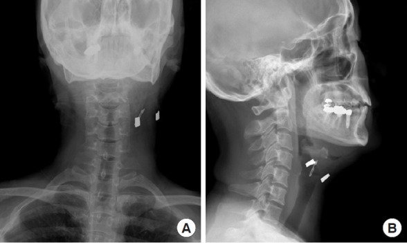 Surgical extraction of a cannula tip embedded in the neck after liposuction at an external facility: a case report.