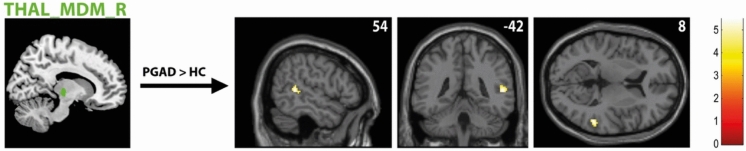 Investigating brain activity at rest in patients with persistent genital arousal disorder (PGAD) using functional magnetic resonance imaging.