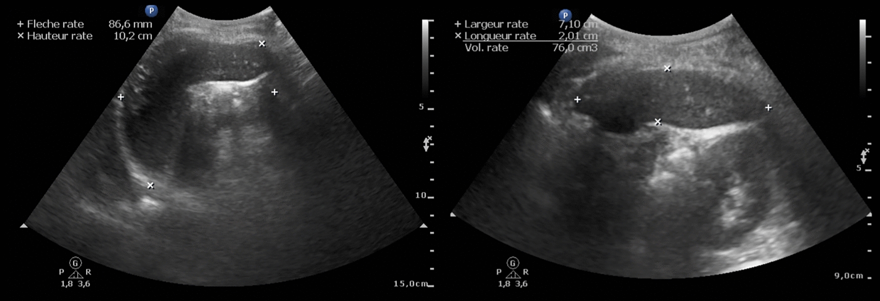 Association between Loa loa microfilaremia and anatomical hyposplenia in a rural area of the Republic of Congo: a population-based cross-sectional study.