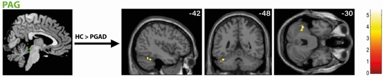 Investigating brain activity at rest in patients with persistent genital arousal disorder (PGAD) using functional magnetic resonance imaging.